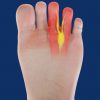 Sole Motion Mortons Neuroma