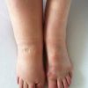 Sole Motion Lymphoedema